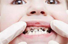 儿童龋齿的常见原因有哪些