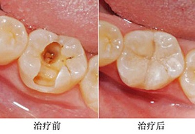 怎样保证根管治疗疗效