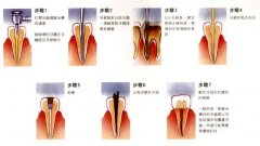 做根管治疗多少钱