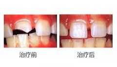 牙齿修复案例