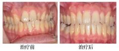 牙齿拥挤正畸案例