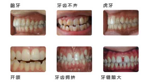 牙齿隐形矫正的费用